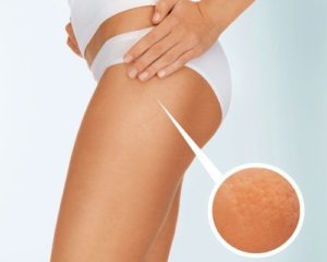 crema anticellulite come scegliere quella giusta