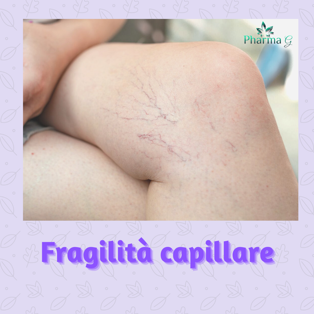 fragilità capillare, capillari fragili, vene varicose, diosmina, varici, insufficienza venosa cronica, unic 1000, daflon